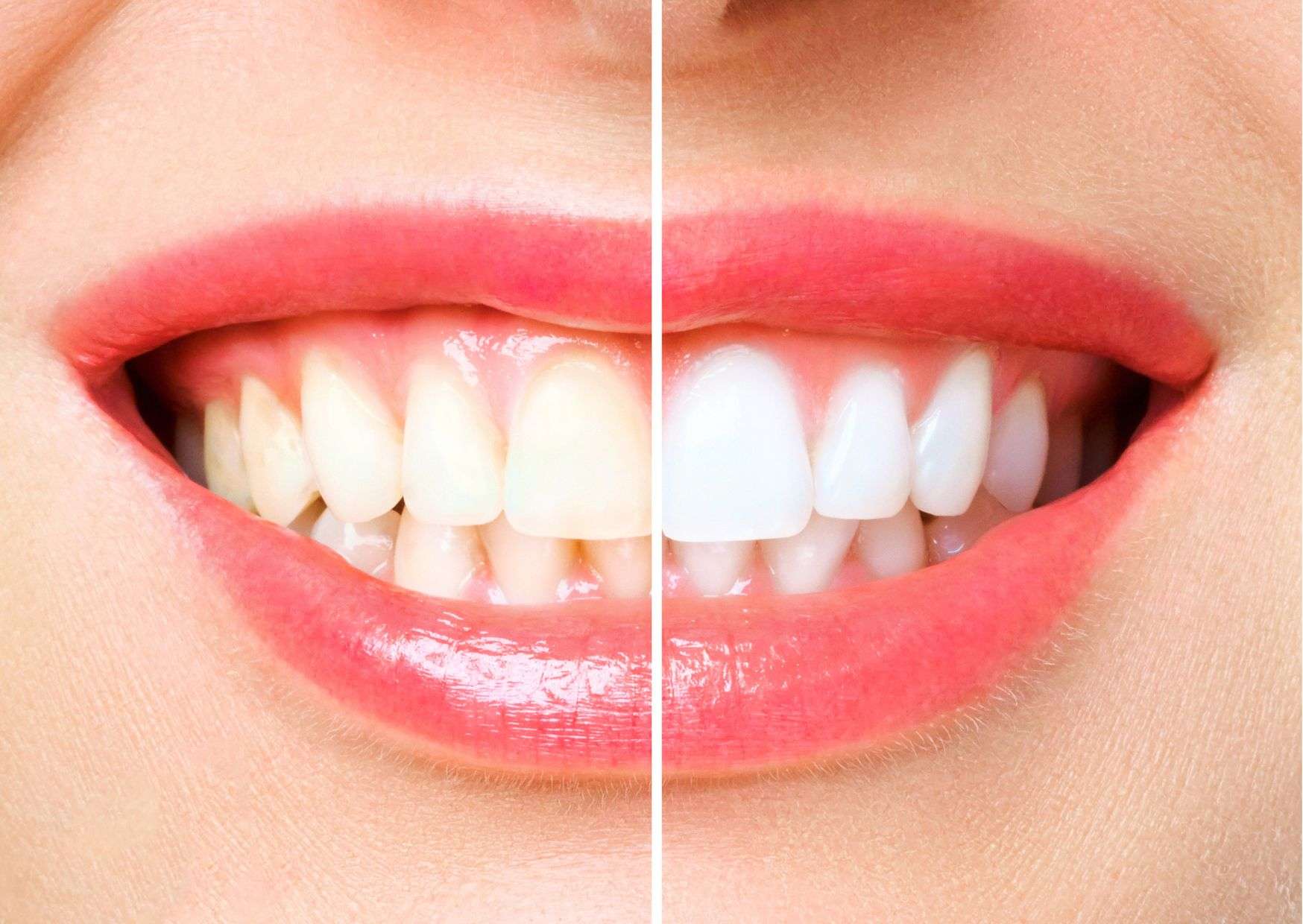 Blanquejament dental a Sabadell Blanquejament dental Sabadell